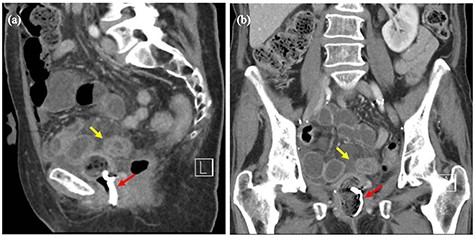 (a and b) Computed tomography images of the pelvis before surgery. Red arrows showing packing material in the vaginal vault. Yellow arrows showing loops of thick-walled distal small bowel.