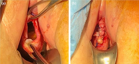(a) Vagina introitus after removal of packing material. A prolapsed vaginal vault with a defect demonstrated. (b) Vaginal vault defect repaired with continuous 0 Vicryl.