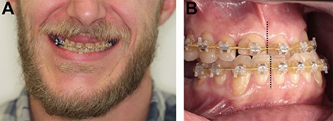 (A and B) The clinical baseline of the patient with a skeletal Class III (a) malocclusion with a rotation of the maxilla to the right and a rotation of the mandible to the left side (b: black lines).