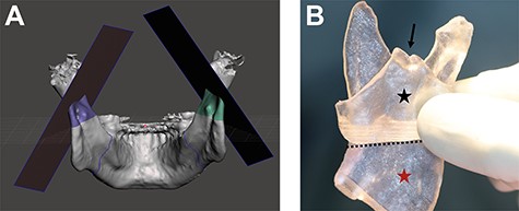 (A and B) Digital planning of the bilateral mandibular osteotomy (a). (b) 3D-printed model of the ascending mandibular ramus (red asterisk) including a patient-specific 3D-printed cutting guide for HOSO (black asterisk) positioned on the outside of the ascending mandibular ramus and fixed by hooking in the incisura semilunaris (black arrow). The 3D-printed cutting guide is marking the osteotomy line on the outside of the ascending mandibular ramus above the mandibular foramen (black line) as well as the angle of the osteotomy line.