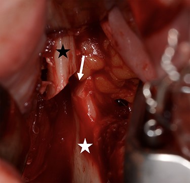 Intraoperative situation after HOSO osteotomy of the right ascending mandibular ramus (white arrow) demonstrating the ascending upper mandibular bone carrying the joint (black asterisk) and lower mandibular bone carrying the teeth (white asterisk).