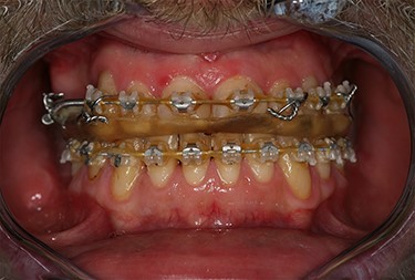 Postoperative situation showing a normal occlusion without any nerve disturbances.