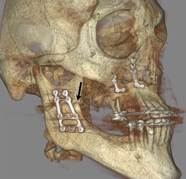 The 3D reconstruction of the postoperative CBCT scan is illustrating the right ascending mandibular ramus including the HOSO osteotomy line (black arrow) and the inserted osteosynthesis plates in the maxilla and the mandible after bimaxillary osteotomy.