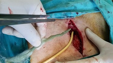 Identification of gastrocutaneous fistula and placement of foley catheter. Gradual retraction of the foley catheter and preparation of the filling by twisting it and holding it in the right direction (the foley catheter as a guide).