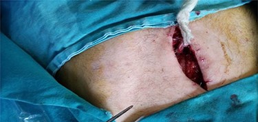 Filling is placed and fixed to the wall around the external fistula orifice and to the fascia.