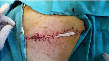 Trionic filling fixed with two sutures for skin and skin closure.