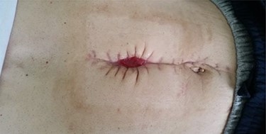 Day 20 after the intervention. Closed fistula.