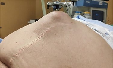 Incarcerated incisional hernia.