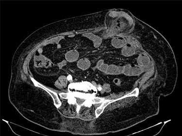 Abdominal CT: hernia content composed of intestinal loop and densification of the mesentery with gas bubbles.
