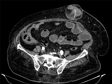 Abdominal CT: image of high-density and filiform morphology compatible with FB.
