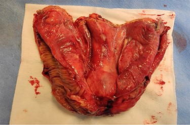 Open enterectomy specimen, in which marked thickening of the mesentery is identified.