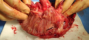 Open enterectomy specimen, in which perforation is identified in the mesenteric side of the intestinal wall by a FB.