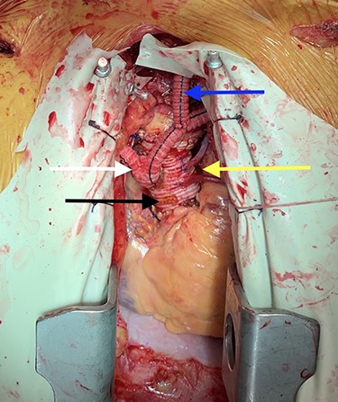 Image depicting prosthetic aorta (black arrow), aortocoronary bypass grafts (yellow arrow), bilateral aorto-axillary bypass grafts (white arrow) and left axillary-to-carotid bypass graft (blue arrow).