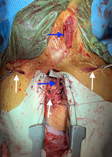 Image depicting bilateral aorto-axillary bypass grafts (white arrows) and left axillary-to-carotid bypass graft (blue arrows).