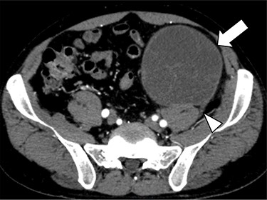 Contrast-enhanced CT confirmed a 10-cm hypodense solid mass (arrow) in the retroperitoneum of the lower left abdomen. It showed that the tumor was contiguous with the third lumbar nerve (arrowhead), suggesting that it was a schwannoma.