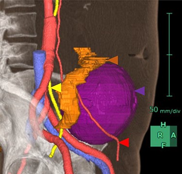 3D image constructed based on CT scans. Purple area is the tumor, yellow area is the left ureter, red areas are the left testicular arteries and orange area is the sigmoid colon.