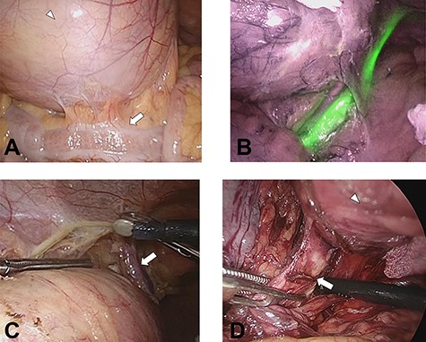 (A) The tumor (white arrowhead) was on the dorsal side of the sigmoid colon (white arrow) in the lower left abdomen. (B) Left ureter is clearly recognized using an infrared imaging videoscope. (C) The left testicular arteries and veins (white arrow) could be separated without injury. (D) The third lumbar nerve (white arrow) continuous with the tumor (white arrowhead).