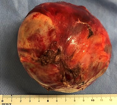 Macroscopic findings of the tumor.