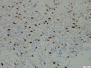 Microscopic findings of the tumor. Immunostaining for S-100 protein was positive.