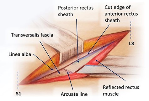 Posterior rectus sheath exposure through a midline approach.