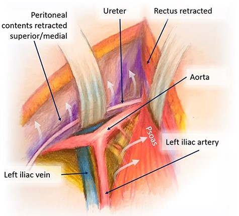 Mobilization of the peritoneal cavity and accessing the retroperitoneum.