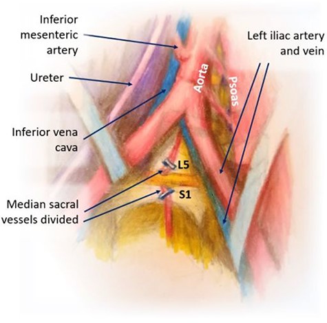 Division of iliolumbar, lumbar and median sacral vessels; exposure of L5-S1.