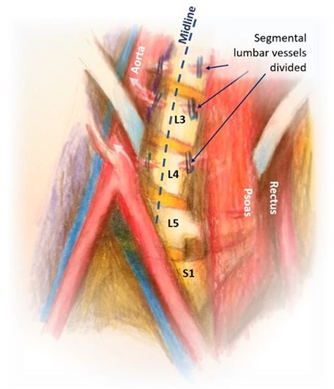 Mobilization of the aorta and IVC with exposure of the spine.
