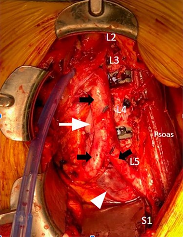 Intraoperative anterior lumbar interbody fusion L2-S1; solid black arrow, top: aorta; solid black arrows, bottom: right and left common iliac arteries; solid white arrow, top: Inferior vena cava; solid white arrow, bottom: left common iliac vein