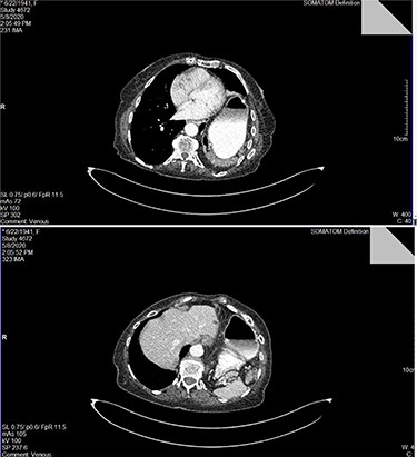Top image: identification of the dilated stomach and segment of intestine in the left hemithorax in CT scan with intravenous contrast media; bottom image: identification of the spleen posteriorly to the dilated stomach within the right hemithorax.