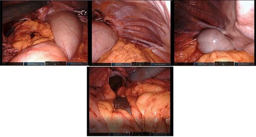 Top left: reduction of the dilated stomach from the hernial sac; retraction of the anterior border of the hiatus; top middle: presence and reduction of omentum from the hernial sac; top right: identification of the large intestine within the Bochdalek hernia; bottom middle: reduction of the spleen and great visualization of the large hiatus.