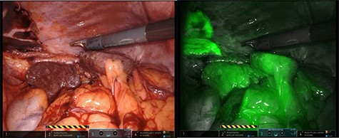The use of intraoperative ICG and the use of Firefly camera to assess blood supply and viability of the spleen.