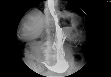 Upper GI fluoroscopy to assess the results of the hernia repair during the third POD.