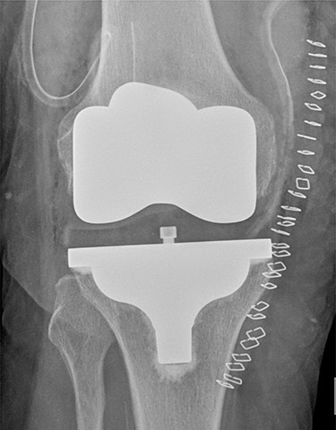 Post-operative TKA (Vanguard CR Zimmer Biomet, Warsaw, Indiana).