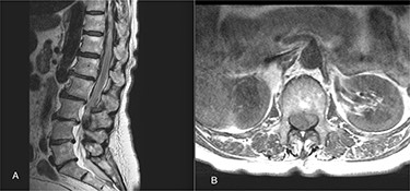 (A) The sagittal T2 FSE MRI show hypointense spindle-like mass from T10 to L3; (B) axial T1w FSE MRI showed iso-hyperintense hematoma compressing the dural sac (L1 level).