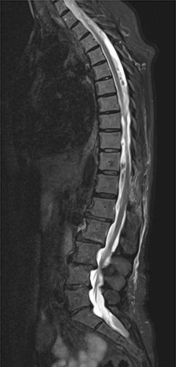 Follow-up MRI; it demonstrates a partial resolution of the hematoma with a confined area of myelopathy at the T12 level.