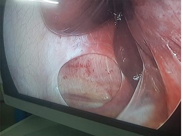 Laparoscopic image of right BH with no sac.