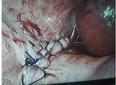 Image after repair of hernia defect.