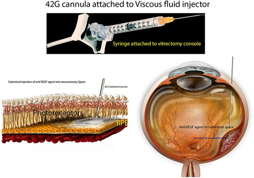 Preparation of the subretinal agent delivery system. (A)Prepared 1-mL syringe coupled with a 42 g/25 g cannula connected to the VFC unit of the vitrectomy device. (B) Histologic schematic of delivery of anti VEGF agent into subretinal space. (C) Schematic of delivery of anti-VEGF agent during vitreoretinal surgery.