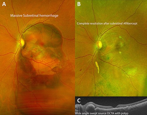 Demonstration of successful resolution of SMH in IPCV by Optos ultra-wide field fundus photography (Optos, Marlborough, MA) and Heidelberg Spectralis OCT (Heidelberg Engineering Inc., Heidelberg, Germany). (A) Fundus photograph at initial visit demonstrating a massive dense subretinal hemorrhage covering entire posterior pole of right eye. (B) Fundus photograph 3 months after pars plana vitrectomy with delivery of subretinal aflibercept demonstrating complete resolution of SMH. (C) Swept source OCT of the macula 1 month post-operatively demonstrating return of near-normal macular contour with polyps associated with idiopathic polypoidal choroidopathy.