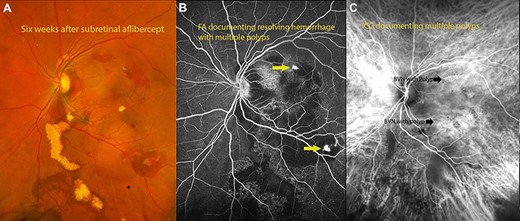 (A) fundus photograph 6 weeks after surgery documenting resolving hemorrhage with residual exudates from polyps. (B) Flourescein angiography documenting polyps with residual hemorrhage. (C) Indocyanin angiography demonstrating areas of polyps with BVNs in the areas of polyps.