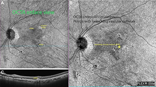 Ziess Plexelite OCT angiography images of IPCV before and after intervention. (A) OCT angiography enface image of a polyp with subretinal hemorrhage before surgery. (B) OCT angiography enface image of resolved hemorrhage with regressed polyp.