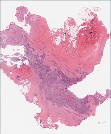 Histology: low-power view showing squamous mucosa (upper left) within an underlying fistula tract associated with a dense cellular infiltrate.