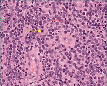 High-power view showing abundant large lymphocytes with the morphology of immunoblasts (small green arrow) and centroblasts (medium red arrow), with reactive plasma cells in the background (long yellow arrow).
