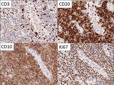 Immunohistochemistry: the large cells expressed CD20 and CD10 and showed high Ki67 proliferation rate. Small reactive T cells were present in the background (CD3).