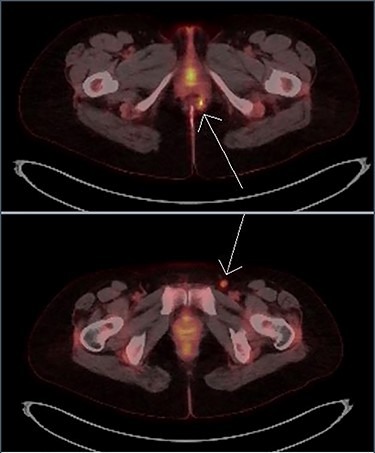 Transaxial PET scan. Upper view shows moderately intense uptake in the left perianal region. Lower view shows mild uptake in the left inguinal node.