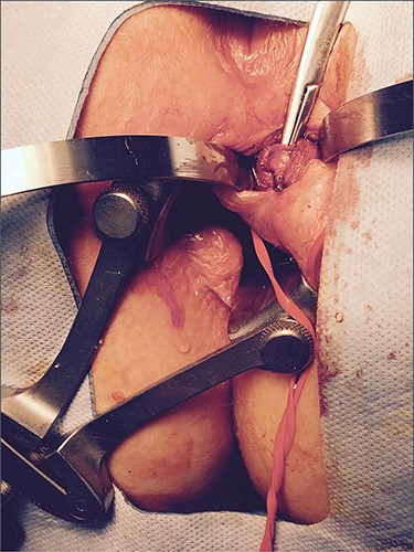 Operative photograph demonstrating the fistula tract
