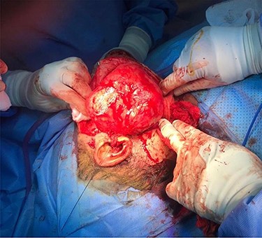 Total right parotidectomy.