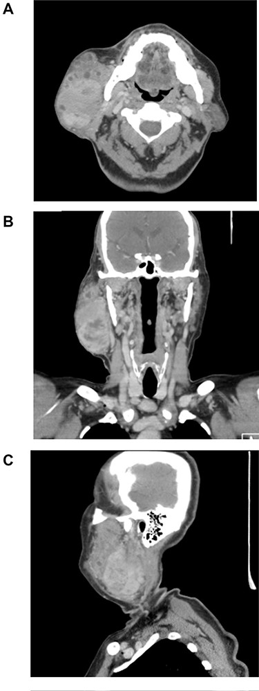 Head and neck CT on the axial (A) coronal (B) and sagittal (C) planes.
