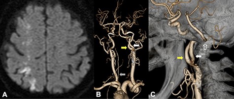 DWI on MRI showed infarction suggestive of high signal intensity lesions at the border zones between the anterior and middle and the middle and posterior cerebral artery territories (A); CTA from a posterior view revealed that PPHA (white arrow) originated from the posterior wall of the ICA (yellow arrow); the ipsilateral vertebral artery was absent, and the contralateral VA was rudimentary (B, gray arrow); CTA from a medial view revealed that PPHA entered the cranium through the hypoglossal canal (C, white line arrow).