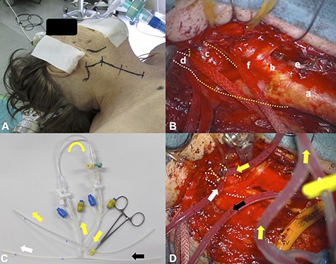 The surgical set-up is shown; the skin incision was performed along the anterior rim of the sternocleidomastoid muscle, slightly changing its direction at the right mandibular angle to the mastoid process (A); the right CCA (a), ECA(b), ICA (c, yellow dotted line), PPHA (d, white dotted line), superior thyroid artery (e) and hypoglossal nerve (f) were exposed (B); the three-way junction tube shunted the blood flow from the right CCA (black arrow) to ICA (yellow arrow) and PPHA (white arrow); the ICA (yellow dotted line) and PPHA (white dotted line) are shown (C and D).